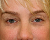 Feel Beautiful - Blepharoplasty Upper Eyelids 104 - Before Photo